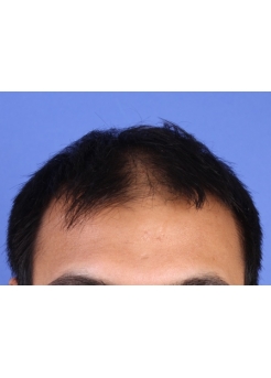 Before Hair Transplant&nbsp;2 Sessions (Areas)